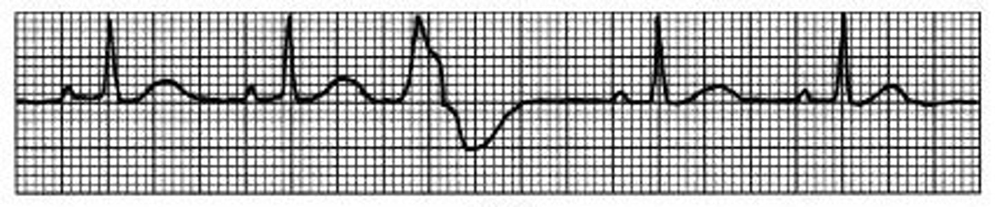<p>name two identifying factors of a Premature Ventricular Contraction</p>