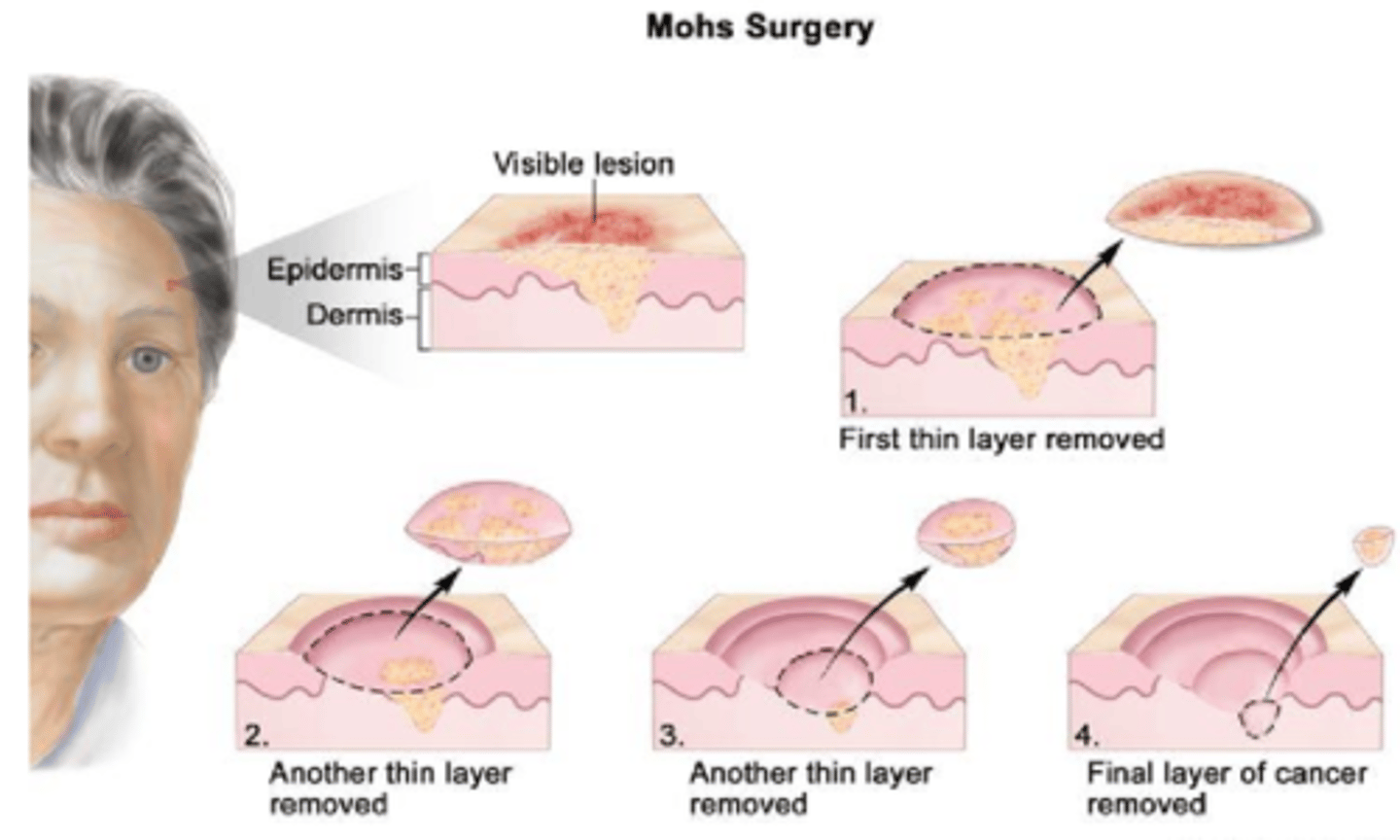 <p>removing one layer at a time, analyzing each layer at each depth for cancerous cells to ensure all are removed</p>