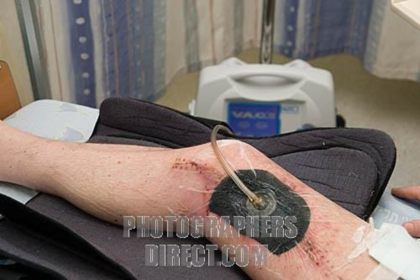 <p>Delivers negative pressure/ sub atmospheric pressure (suction) to the wound bed</p>