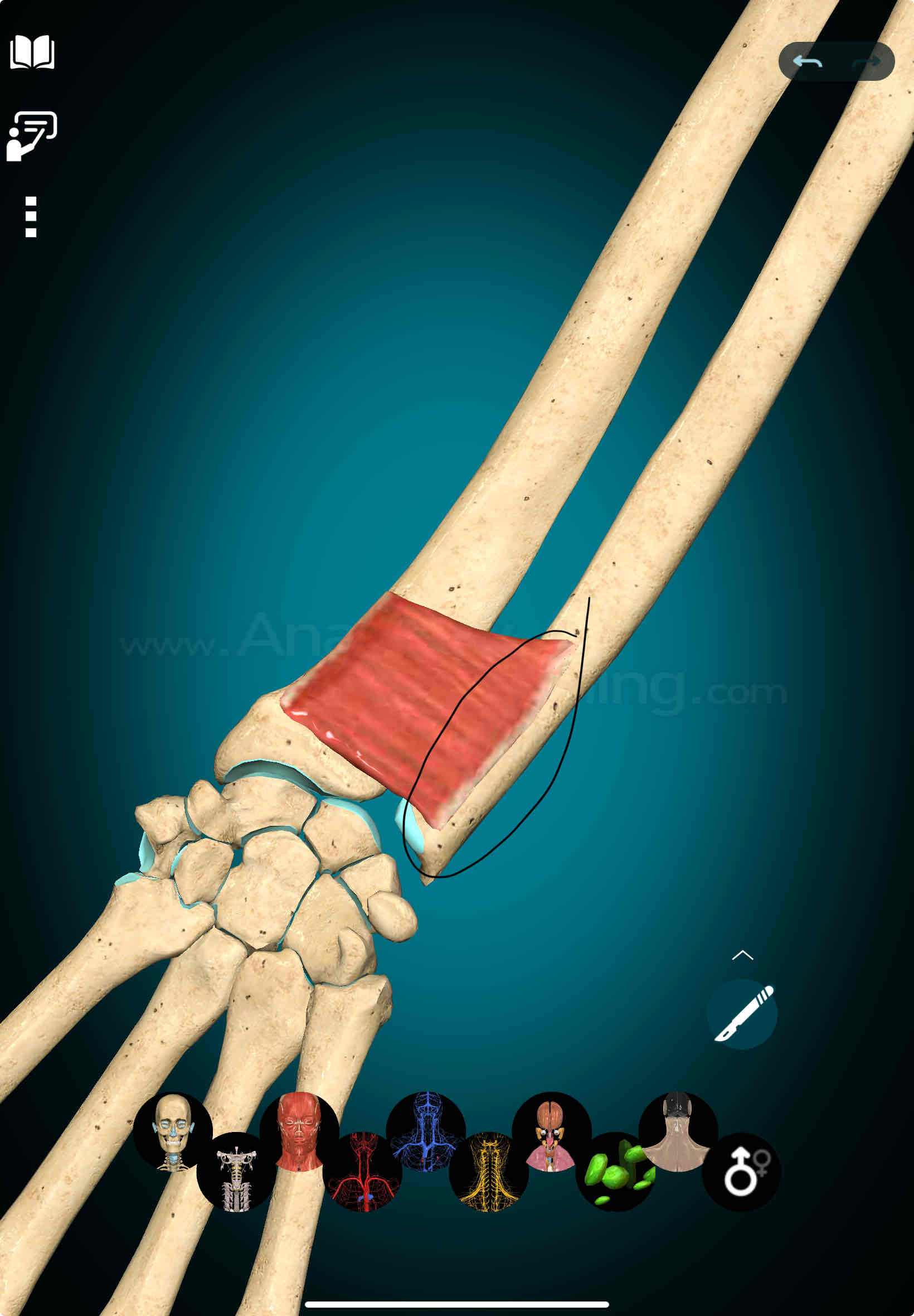 <p>Pronator Quadratus Origin</p>
