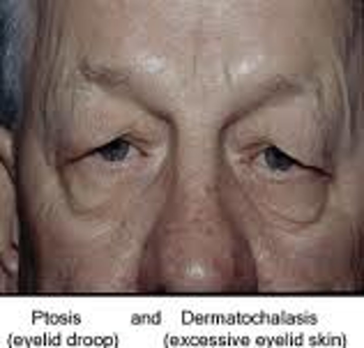 <p>* Ptosis is caused by a weakening of muscle that results in the upper eyelid drooping over the eye.</p><p>* Dermatochalasis is caused by excess skin, fat, or muscle in the eyelid area.</p>