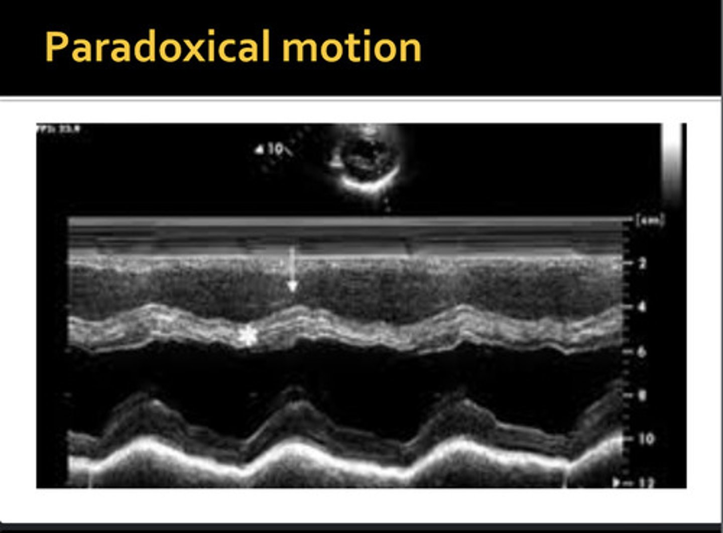 <p>movement away from the opposite wall during systole; IVS moves away from free wall and posterior inferior away from pericardium</p>