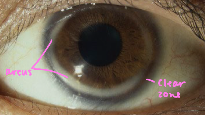 <ul><li><p>most common peripheral corneal opacity</p></li><li><p><strong>Symptoms</strong>: None</p></li><li><p><strong>Onset</strong>: all ages</p><ul><li><p><span>Younger individuals: related to systemic disease (high lipids)</span></p></li><li><p><span>Older individual: no systemic association</span></p></li></ul></li><li><p><span><strong>Presentation</strong>: stromal lipid deposition</span></p><ul><li><p><span>Starts <em>superior and inferior</em> and progressed circumferentially</span></p></li><li><p><span>Will be 1mm wide</span></p></li><li><p><span>Will have a <em>clear zone</em> between corneal opacity and limbus</span></p></li></ul></li><li><p><span><strong>Treatment</strong>: none unless suspect systemic association</span></p></li></ul><p></p>