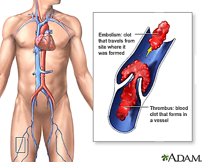 <p>A blood Clot that forms in a vessel</p>