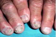 <p>COMMON DISORDERS SEEN WITH AGING</p><p></p><ul><li><p>INFECTION (fungal)</p></li><li><p>caused by dermatophytes, <mark data-color="red" style="background-color: red; color: inherit;">yeasts, and non-dermatophyte molds</mark></p></li><li><p><strong><em>infection of the nail plate, nail bed, or both</em></strong><span>. </span></p></li><li><p><span>The nails typically are </span><span style="color: red;">deformed and discolored white or yellow.</span></p></li></ul><p></p>