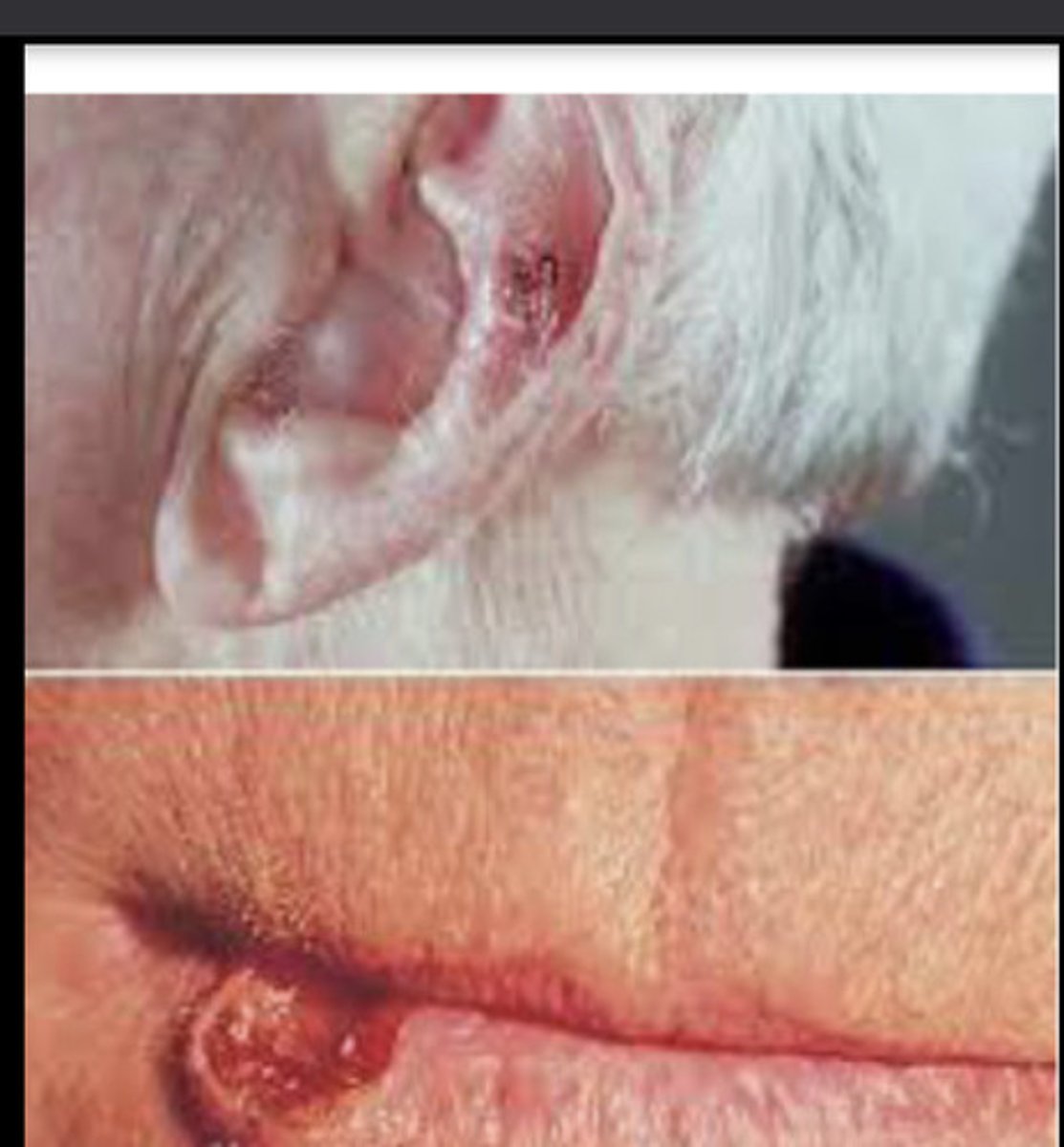 <p>Squamous Cell Carcinoma</p>