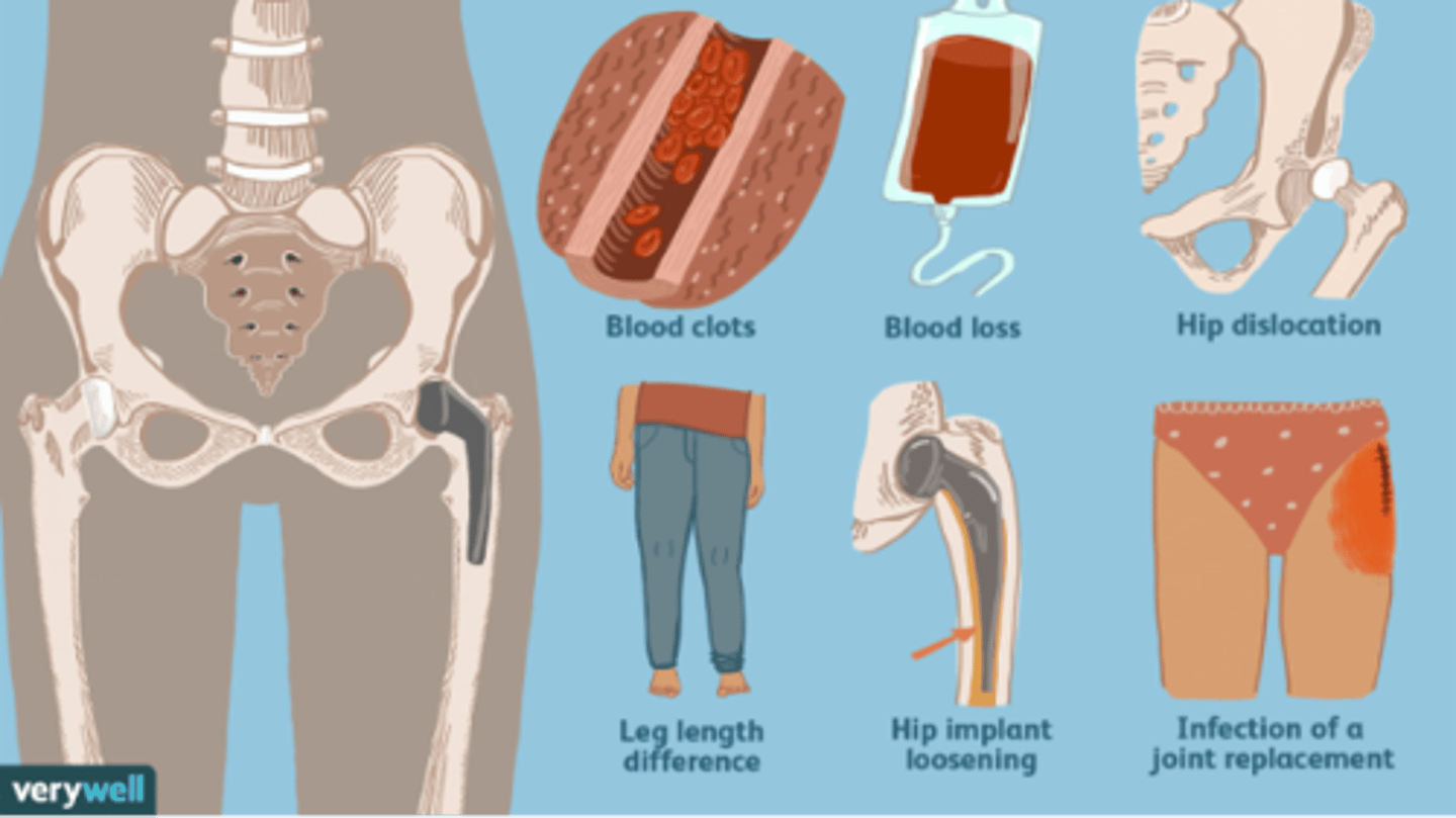 <p>-Blood clots<br>-Blood loss<br>-Hip dislocation<br>-Leg length difference<br>-Hip implant loosening or wearing<br>-Infection of a joint replacement<br>-Implant rejection</p>