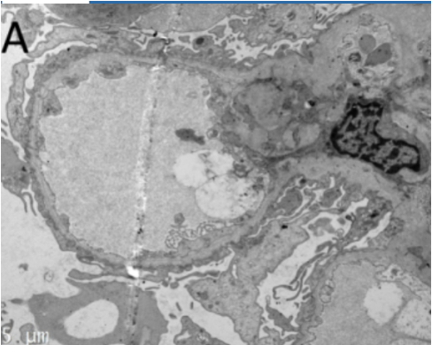 <p>A 12-year-old boy is evaluated for recurrent episodes of gross hematuria, most often following upper respiratory tract infections. His mother reports that he has also been struggling in school because of progressive hearing difficulties. Family history reveals that two maternal uncles developed kidney failure in early adulthood. On exam, his blood pressure is 145/92 mmHg. Urinalysis shows hematuria with red blood cell casts and mild proteinuria. Laboratory studies demonstrate normal complement levels. Renal biopsy reveals irregular thickening, thinning, and splitting of the glomerular basement membrane with a “basket-weave” appearance on electron microscopy.</p><p>Which of the following is the most likely diagnosis? </p>