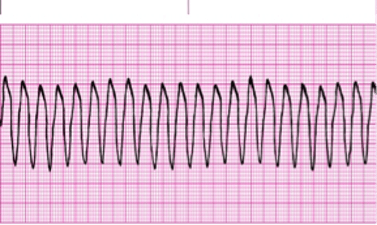 <p>this arrhythmia is characterized by "successive runs of PVCs," and is lethal</p>