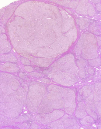 <p>mitä kuvassa näkyy yleisesti ja millainen regeneraatio? (vinkki: maksaskirroosi)</p>