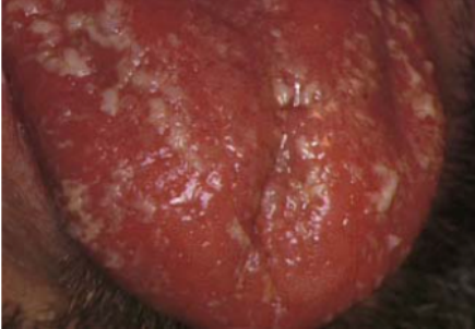 <p>Name the oral candidiasis</p>