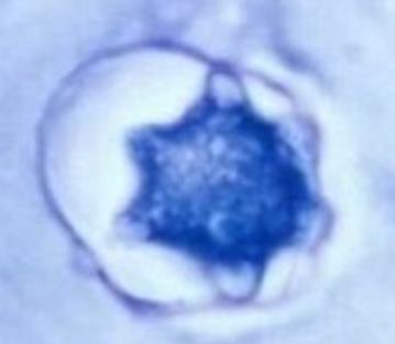 <p><strong>Identify the parasitic stage.</strong></p><ul><li><p><em>Acanthamoeba castellanii</em> cyst.</p></li></ul><div data-type="horizontalRule"><hr></div><p><strong>Mention two morphological characteristics of this stage.</strong></p><ul><li><p>About <strong>15–20 µm</strong> in size.</p></li><li><p>Has a <strong>polygonal double wall with many pores.</strong></p></li></ul><div data-type="horizontalRule"><hr></div><p><strong>Mention the possible human samples used for diagnosis, and the culture medium used.</strong></p><ul><li><p><strong>Samples:</strong> CSF, brain tissue, corneal tissue, and skin biopsy.</p></li><li><p><strong>Culture medium:</strong> Non-nutrient agar (1.5%) enriched with <em>Escherichia coli.</em></p></li></ul><div data-type="horizontalRule"><hr></div><p><strong>Mention the diagnostic methods used for ocular infection caused by this parasite.</strong></p><ol><li><p><strong>Corneal scrapings or sections</strong> examined by <strong>direct microscopy and staining</strong>, or by <strong>cultivation.</strong></p></li><li><p><strong>Laser confocal microscopy</strong> can visualize both <strong>trophozoites and cysts.</strong></p></li></ol><p></p>