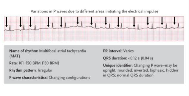 <p>a rhythm related to wandering atrial pacemaker, but with a ventricular rate greater than 100 BPM</p>