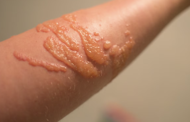 <p>what type of raised, fluid-filled, primary skin lesion is this?</p>