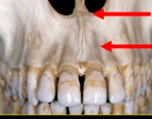 <p>what can you say about the surface anatomy of the maxilla around the teeth themselves?</p>