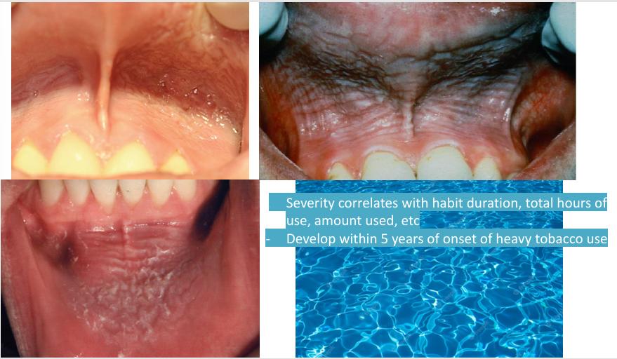 <p>-epithelial alteration in response to repeated placement of smokeless tobacco, in vestibule- keratinocyte edema, hyperkeratosis (sometimes)</p><p>-clinical features: gray-white opalescent area, wrinkly appearance, gingival recession, staining of teeth</p><p>-similar change seen when other bulky materials held chronically in the vestibule</p><p>-stretching of mucosa reveals a distinct “pouch”- flaccid chronically stretched tissues</p>
