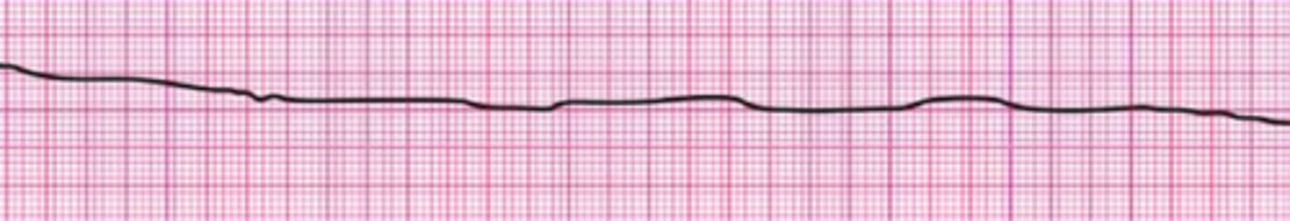 <p>Resume high-quality chest compressions</p>