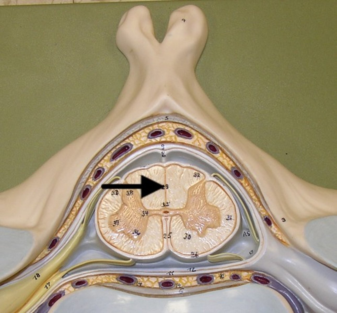 <p>a longitudinal shallow groove on the posterior side of the spinal cord</p>
