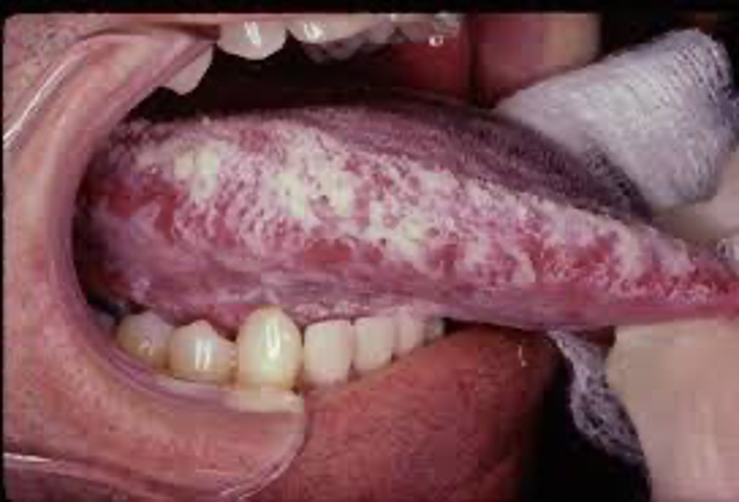 <p>A patient presents with a white, corrugated lesion on the lateral border of the tongue that cannot be wiped off. The patient is immunocompromised.</p><p>This lesion is most strongly associated with which of the following?</p>
