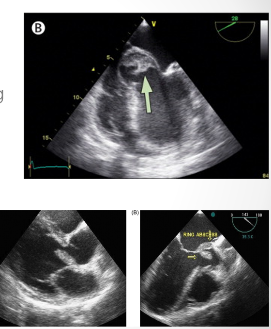 <p>nonhomogenous enclosed area appearing echolucent or echodense</p>