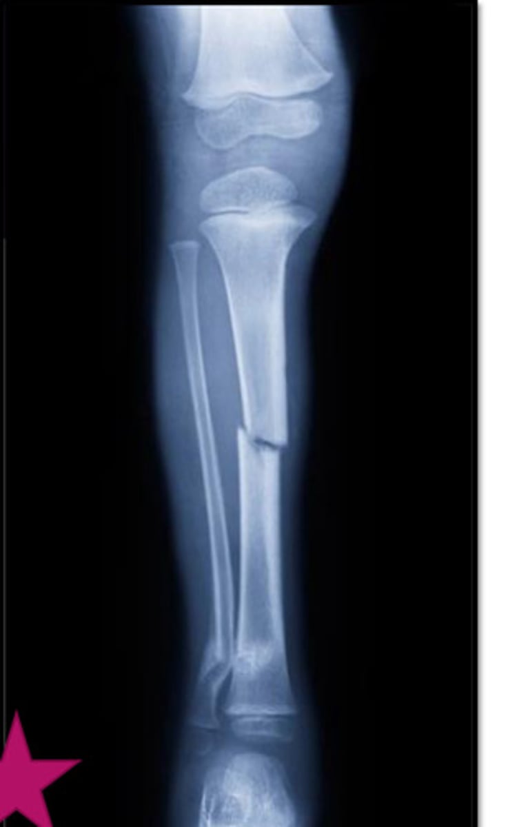 <p>disruption in the continuity of all or part of the cortex(hard outer layer) of a bone</p>