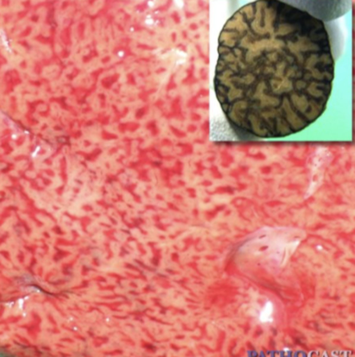 <p>What has caused this gross appearance of this liver?</p>