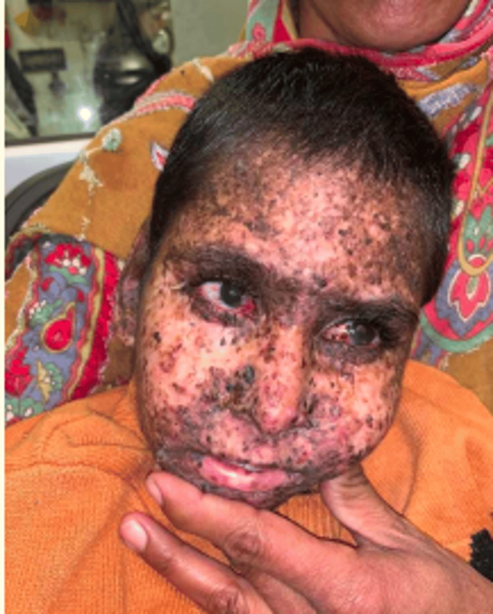 <p>Autosomal recessive = extreme photosensitivity</p><p>- Mutations in 1/7 genes that affect DNA nucleotide excision repair (NER) </p><p>- Patients develop skin cancer at a young age </p>