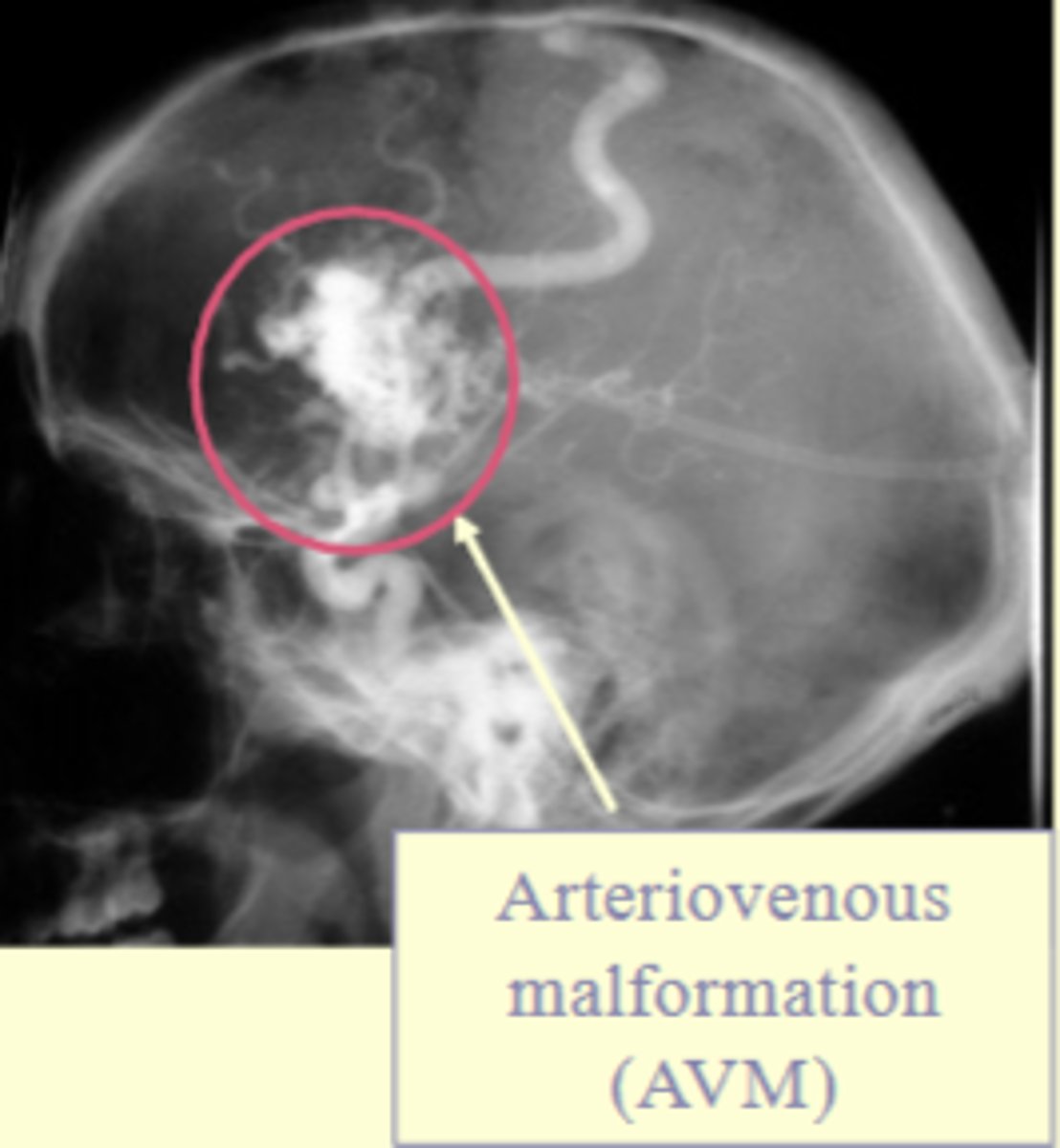 <p>- stenosis (abnormal narrowing) of a vessel</p><p>- aneurysm (ballooning of a vessel)</p><p>- arteriovenous malformation (AVM) (an overgrown tangle of blood vessels</p><p>- thrombolysis (clotting)</p>