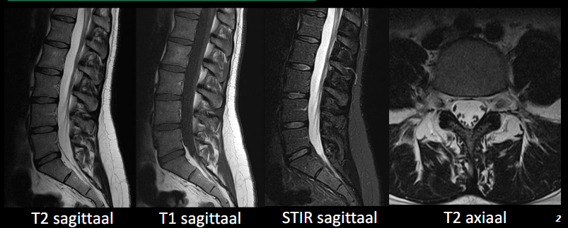 <p>Wat kunnen we kenmerkend op MR herkennen?</p>