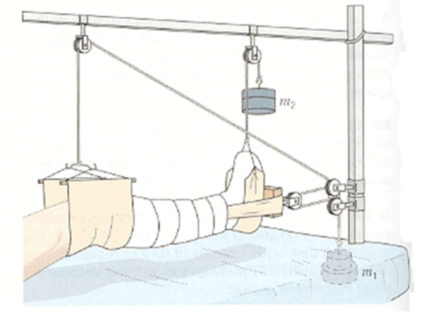 <p>PT Implications of Traction:</p><p>- Do not change positioning of HOB, FOB, placement of blankets, etc.</p><p>- Keep weights haning __________________________</p><p>- __________________________ or active exercise of uninvolved extremities</p>