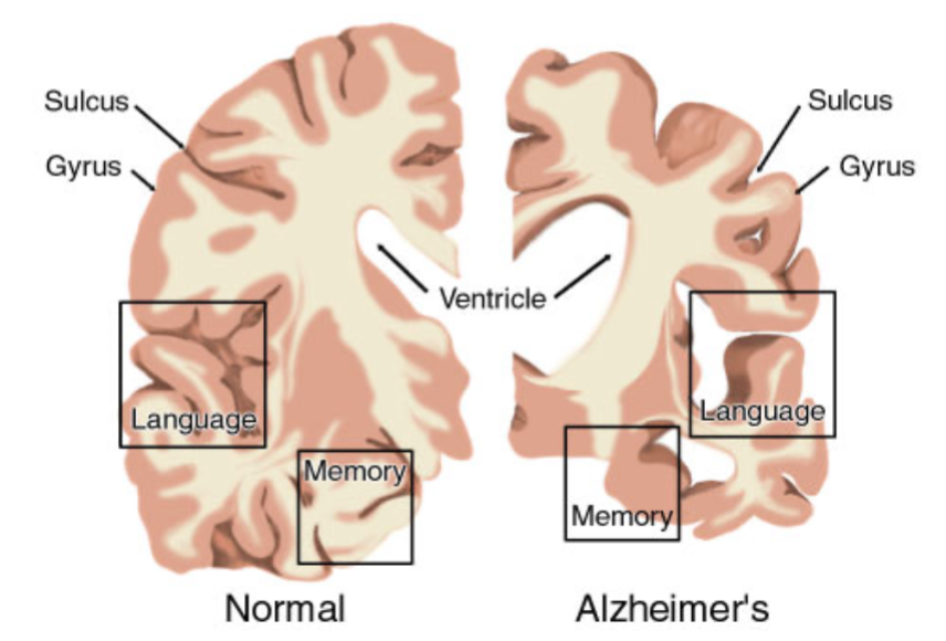 <ul><li><p>formation of amyloid plaques and tau tangles</p></li><li><p>cortical atrophy, neuron loss, and synapse loss</p></li><li><p>increased ventricles, decreased memory and language sections of brain</p></li></ul>