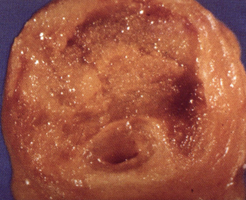 <p>Coronary Artery Calcification</p>