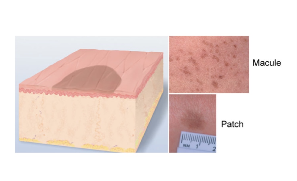 <p>Flat (freckle)</p>