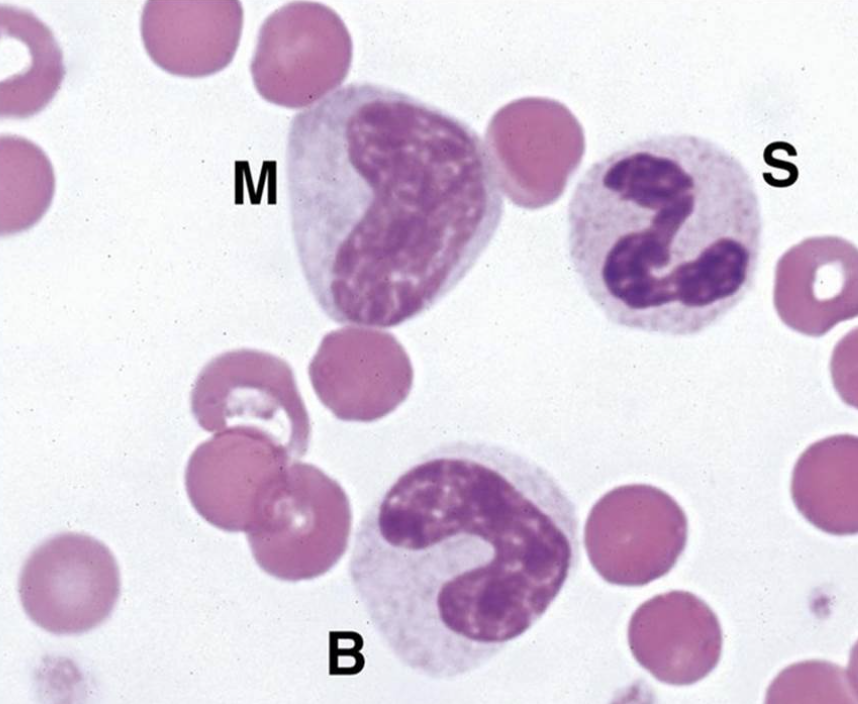 <p><span style="font-family: Lato Extended, Lato, Helvetica Neue, Helvetica, Arial, sans-serif">&nbsp;The 3 cells below were found in circulation and all were identified as neutrophils at different stages of maturation. When this is seen, a _________,_________is said to be present</span></p>