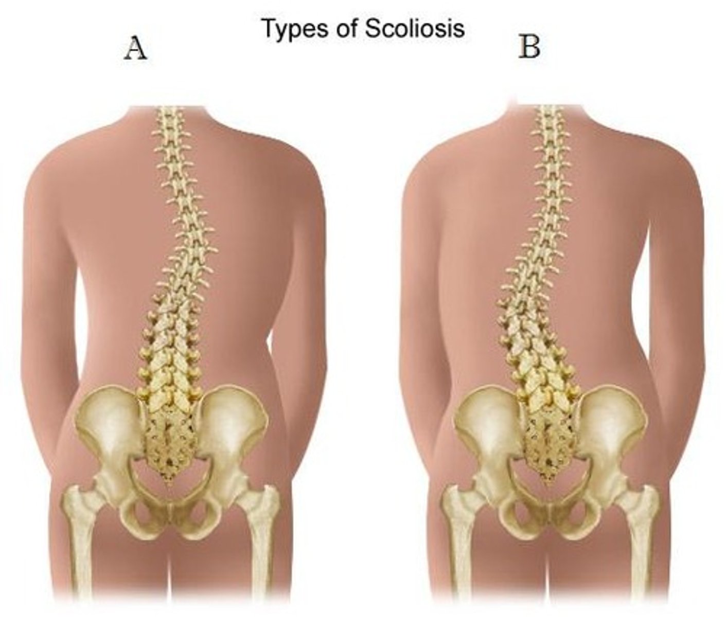 <p>Lateral curvature that can be thoracic, lumbar, or both - rarely cervical.</p>