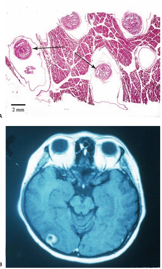 <p>Causes cysticercosis</p>