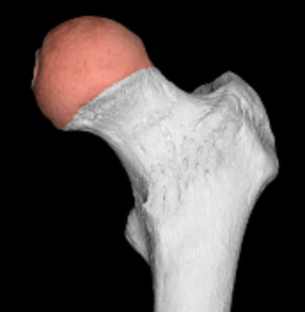 <p>ball of femur</p>