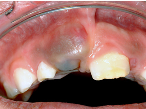 <p>palpable, SC accumulation of extravasated blood; color evolves over time: purple/blue → red/brown → green/yellow</p>