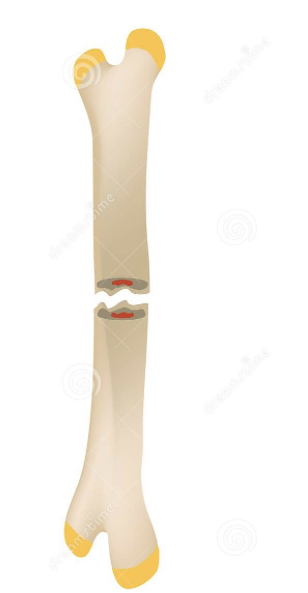 a break that occurs straight across the bone
