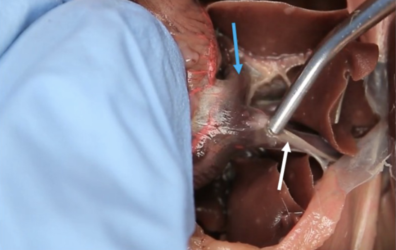 <p>What is blue arrow?</p>