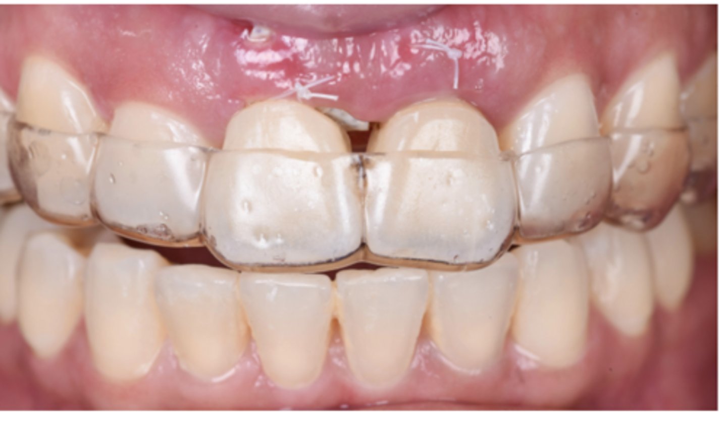 <p>Which of the following best describes an advantage of the Essix retainer (picture showed)? (Select one answer)</p><p>A. It's resistant to catastrophic fracture.</p><p>B. Easy to fabricate, relatively inexpensive.</p><p>C. It offers permanent retention and support.</p><p>D. It requires minimal patient compliance.</p><p>E. It ensures maximum occlusal comfort.</p>