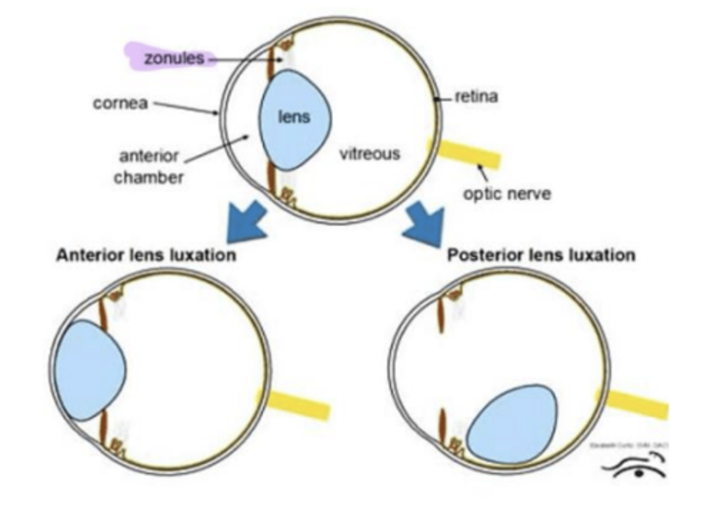 <p>- ADAMST17 gene mutation - responsible for formation and maintenance of lens zonules; Results in anterior lens luxation</p>