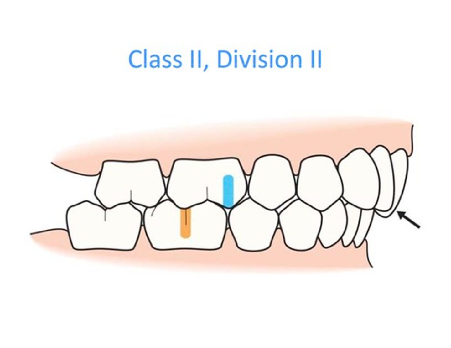 <p>overbite</p>