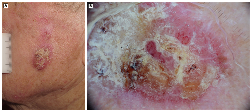 <ul><li><p>rapidly growing, firm, contender intracutaneous nodule</p></li><li><p>skin colored or bluish-red</p></li><li><p>1cm - 2cm+</p></li><li><p>high risk of metastasis</p></li><li><p>located in sun exposed areas</p></li></ul><p></p>