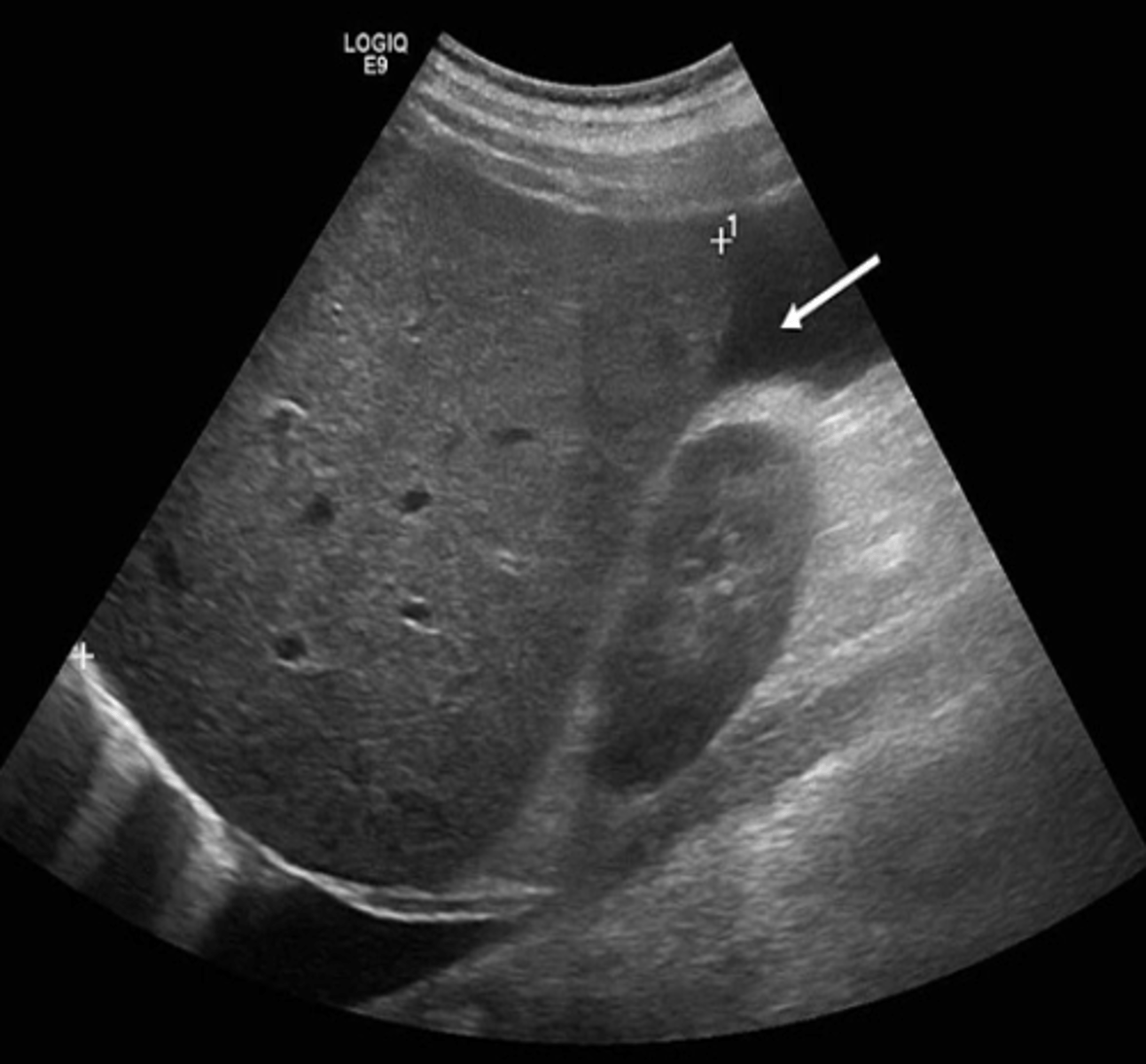 <p>Ascites in the paracolic gutter</p>