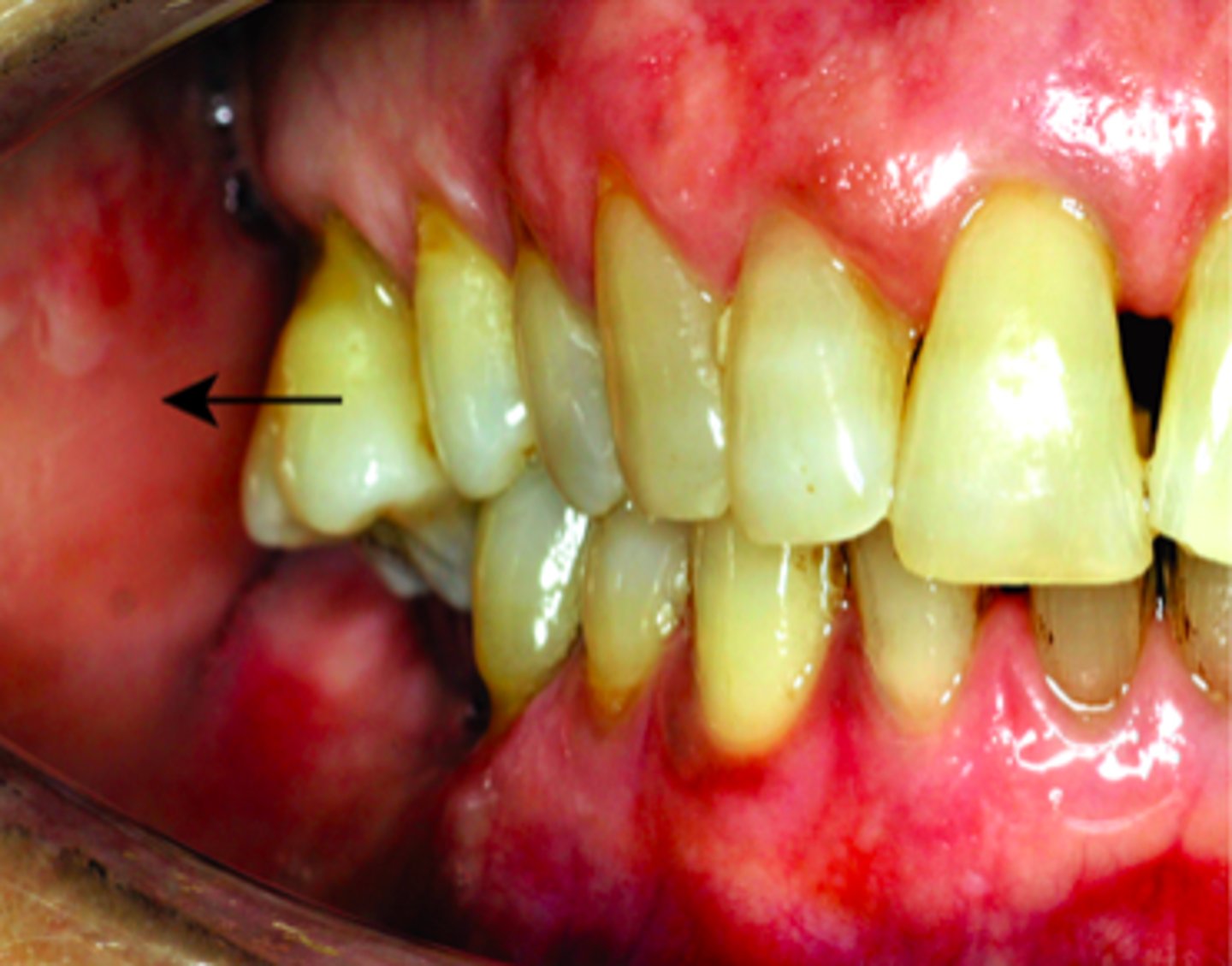 <p>Position buccal/facial to normal</p>