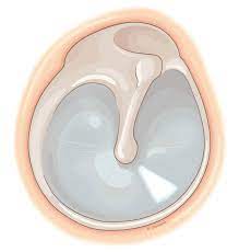 * This part of the TM is larger and stiffer
* Located inferiorly
* Contains all the layers of the ear drum  