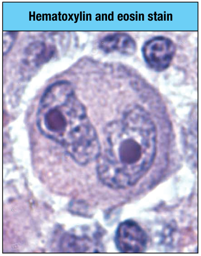 <p>Which type of cancer is associated with the cell shown in the micrograph here? (owl eyes)</p><p>a. Hodgkin’s lymphoma</p><p>b. multiple myeloma</p><p>c. anaplastic large-cell lymphoma</p><p>d. Burkitt’s lymphoma</p>