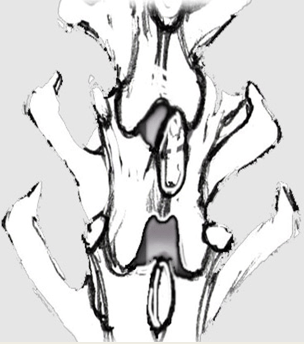 <p>Butterfly vertebrae</p>