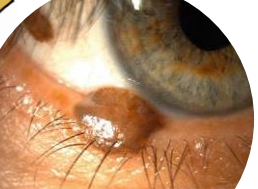 <p><u>Elevated </u>and even colored </p><p><u>Level of Basal epidermis and dermis</u></p><p>Found in young adults</p>